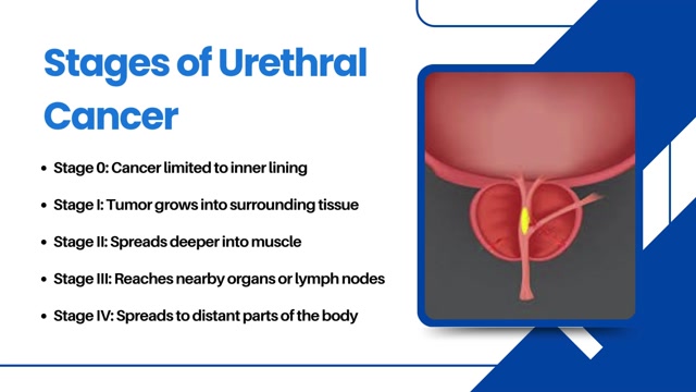 Urethral Cancer Awareness & Advanced Treatment by Dr. Amitabh Singh