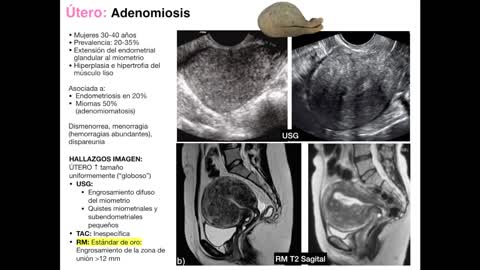 11.3  Imagenologia del utero y enfermedad pelvica inflamatoria