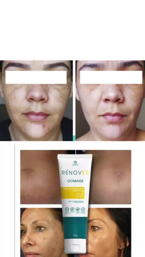 Remova Manchas de Pele com Gomage Akmos. #akmos#melasma #melasmatratamento #muitascoisasstores