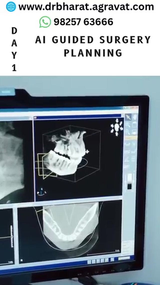  Let AI Plan This Surgery! 4 Teeth Replaced in 3 Days DentoImplaDeck SOP #Shorts #drbharatagravat