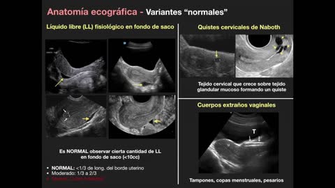 11.1 - Imagen Ginecológica: Métodos de estudio y patología endometrial